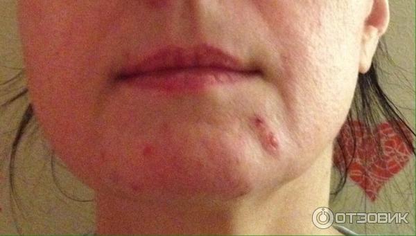 Корректирующий уход двойного действия Vichy Normaderm Phytosolution фото