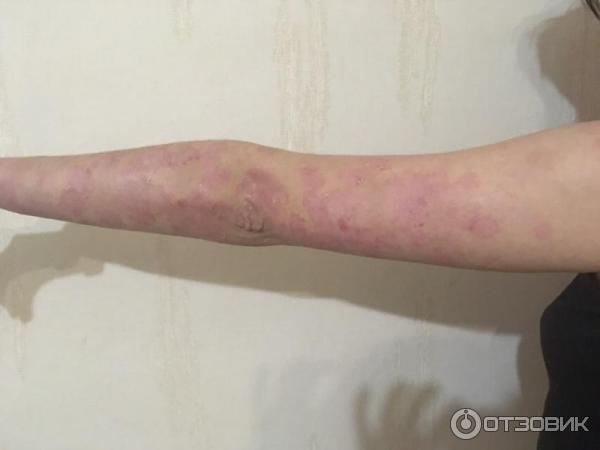 использование мази длится 2 месяца