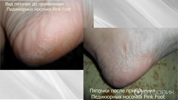 Педикюрные носочки Pink Foot фото