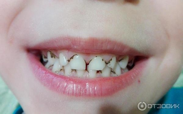 Отбеливание зубов: виды - City Smile