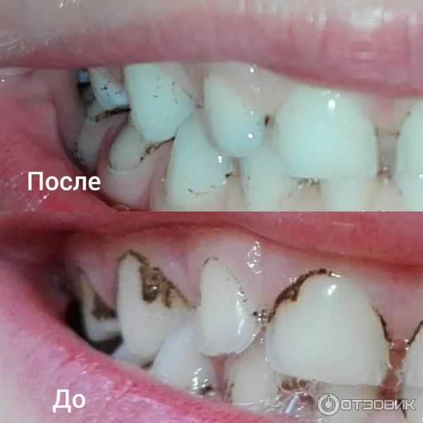 Черный налет на зубах, причины появления, как избавиться, профилактика — ROOTT