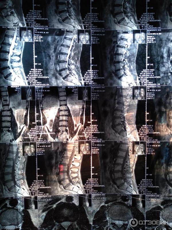 Мрт Поясничного Отдела Позвоночника Цена