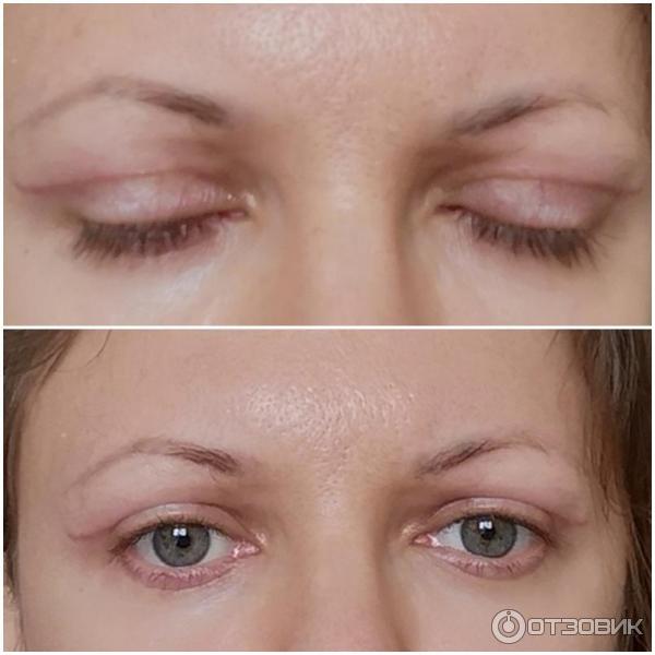 Scars and seals after blepharoplasty