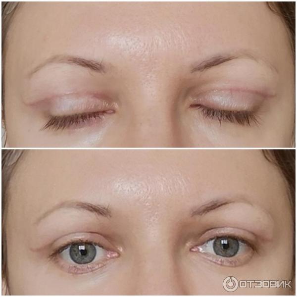 Впалые глаза - Эстетическая и пластическая хирургия - - Здоровье luchistii-sudak.ru