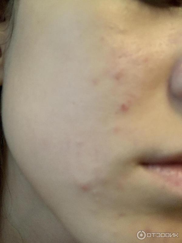 Отзыв о Крем Розамет для лечения розацеа и акне | Дешёвый самообман