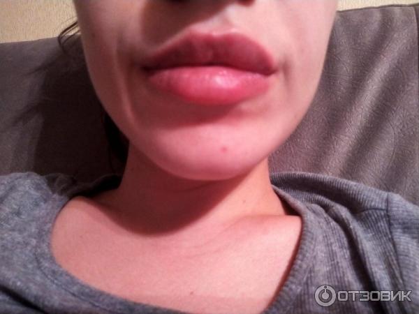 Губы сардиния до и после Отзыв о Увеличение губ препаратом Sardenya Фото до и поле. Особо впечатлительным
